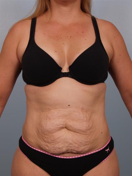 Abdominoplasty - Gilbert, Scottsdale, Glendale AZ